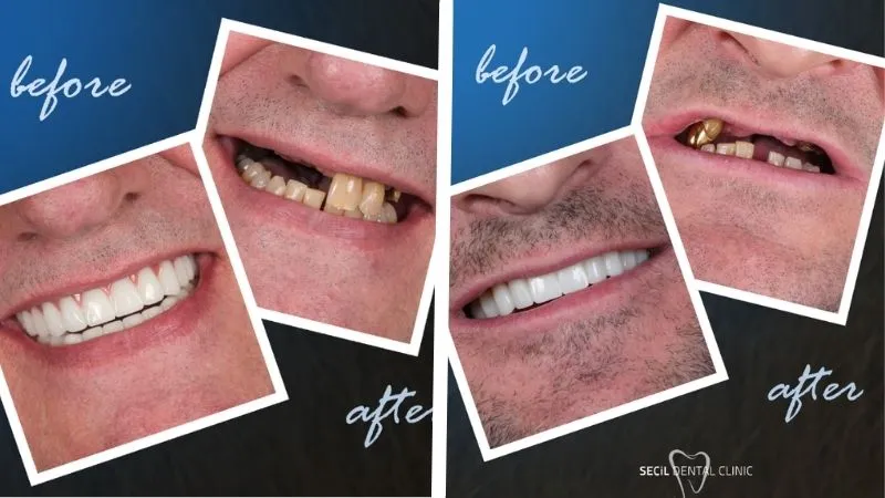 All On 4 Dental Implants Antalya