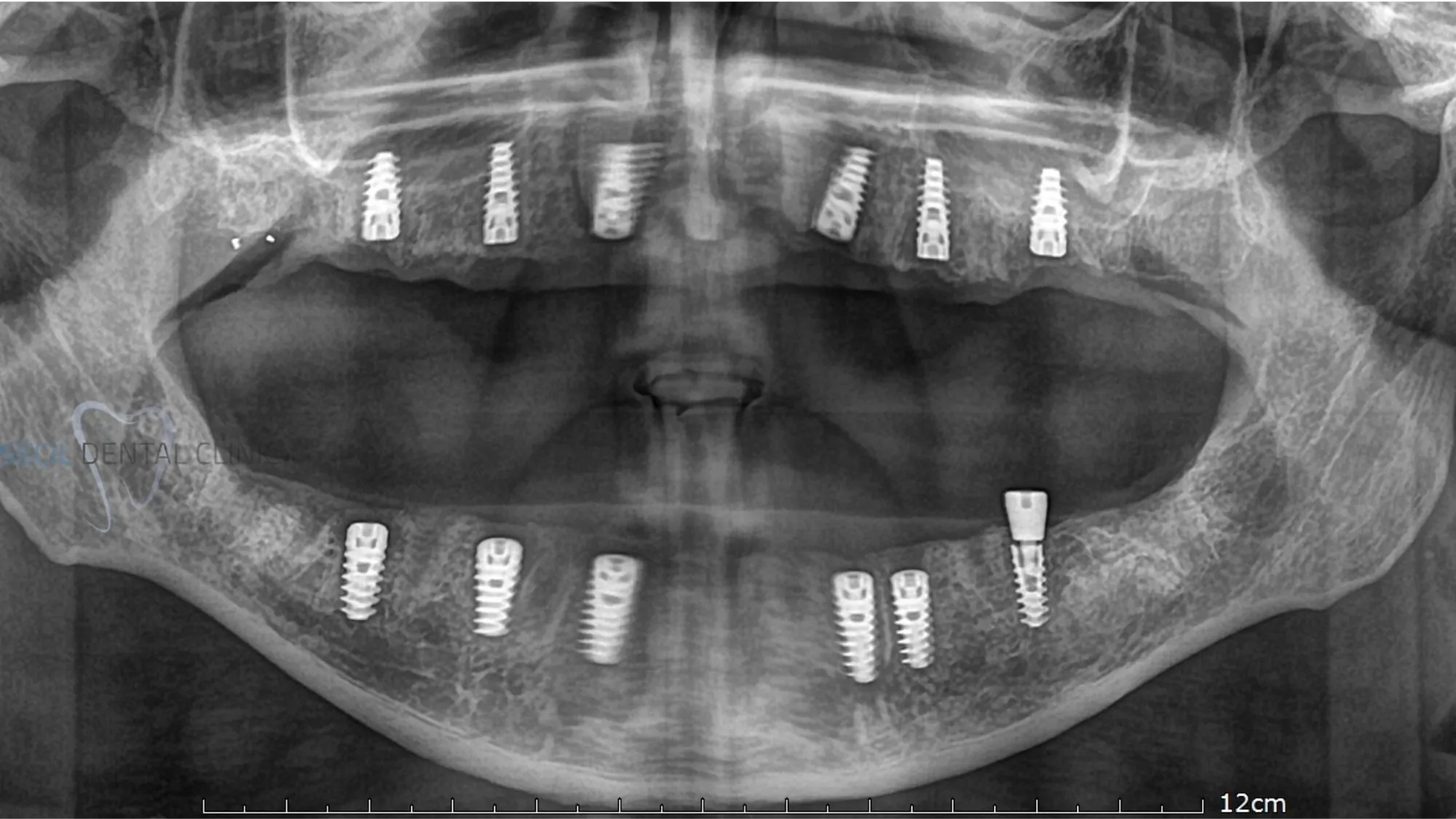 All-on-6 dental implant Turkey