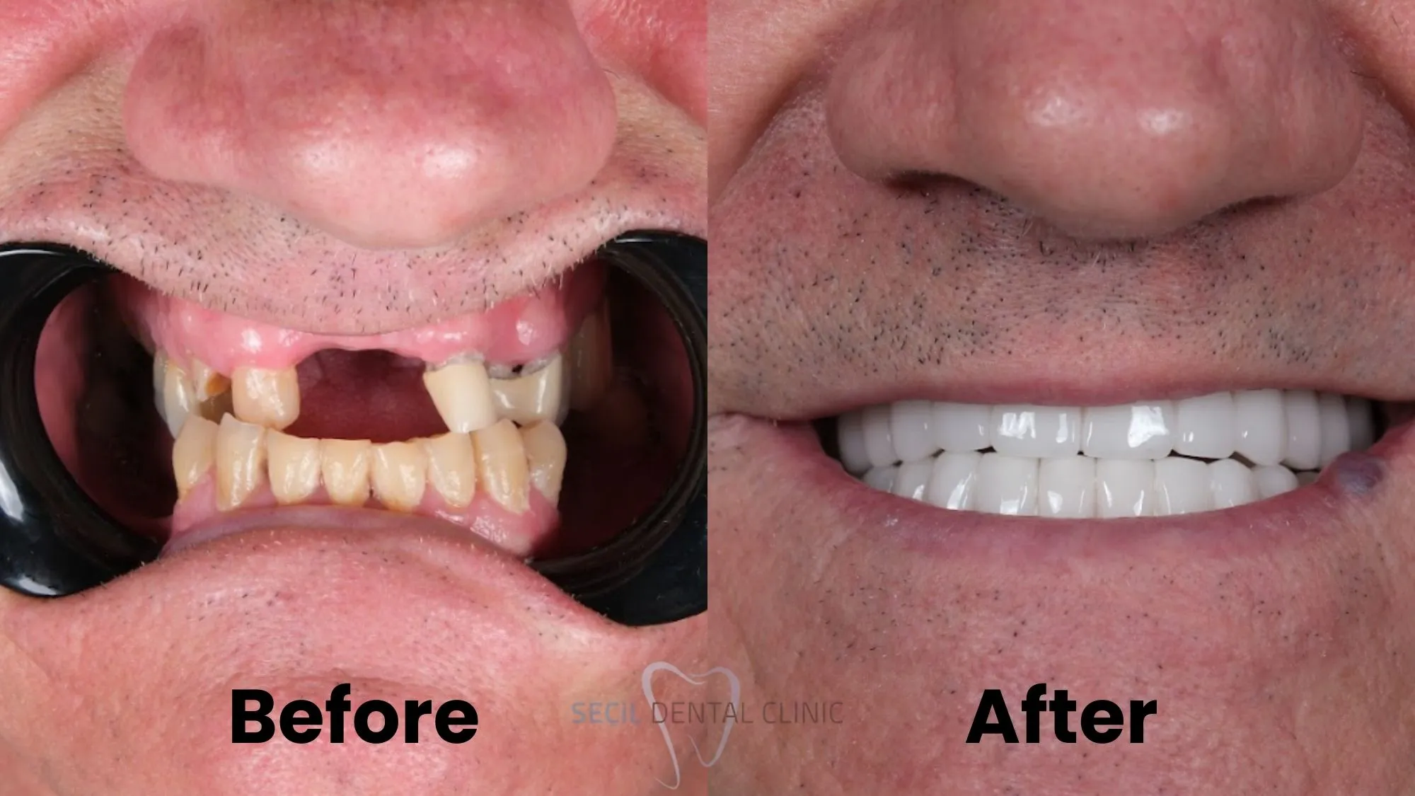 All on 6 dental implants before and after