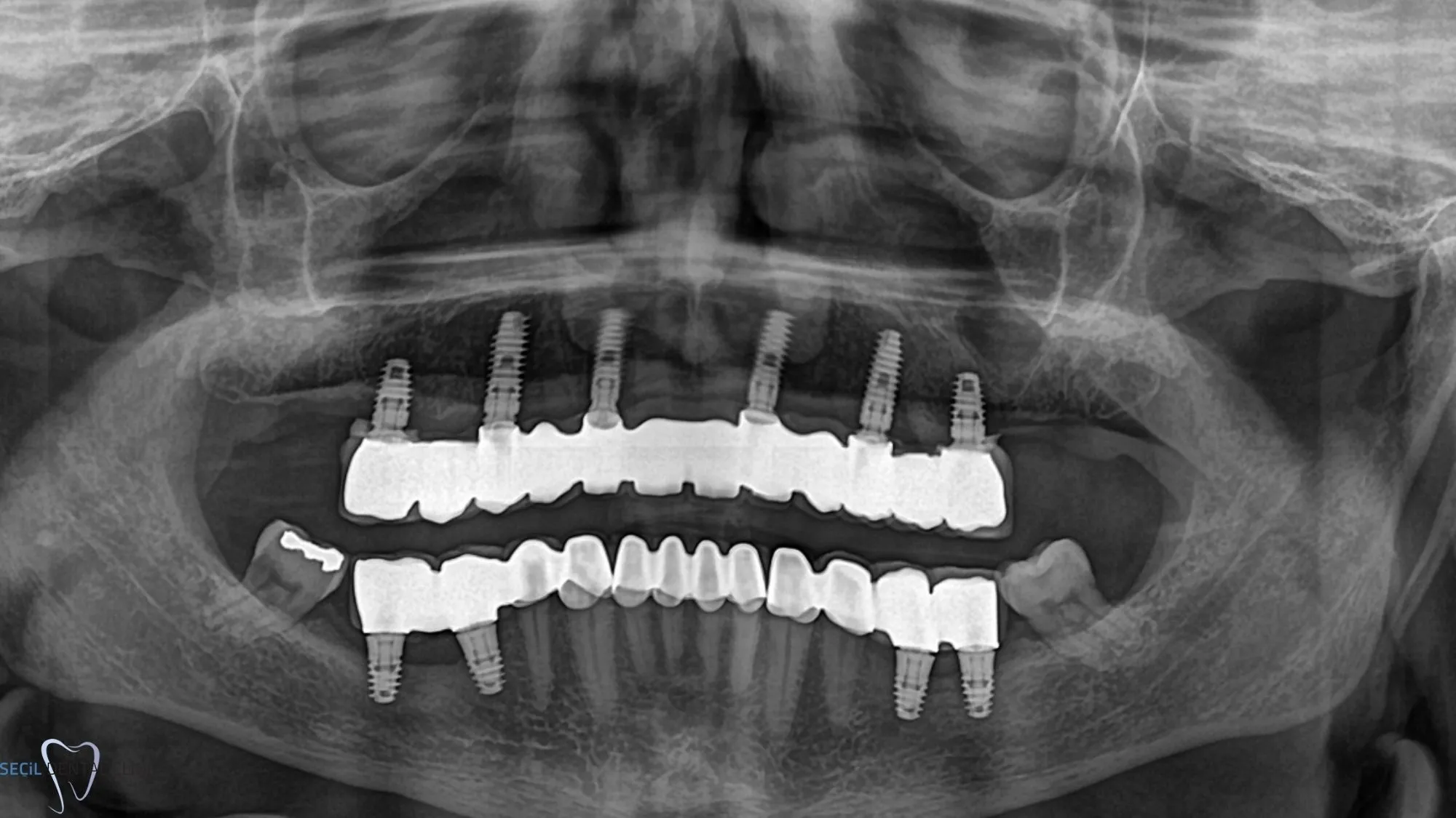 all on 6 dental implants before and after Turkey