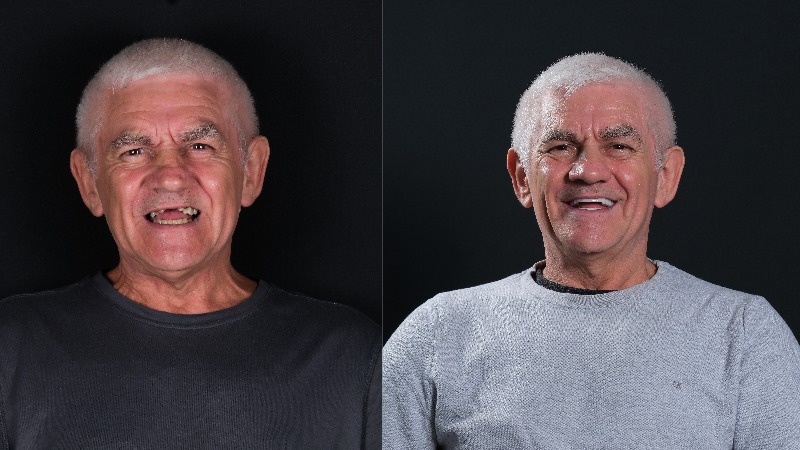 All on 6 dental implants before and after