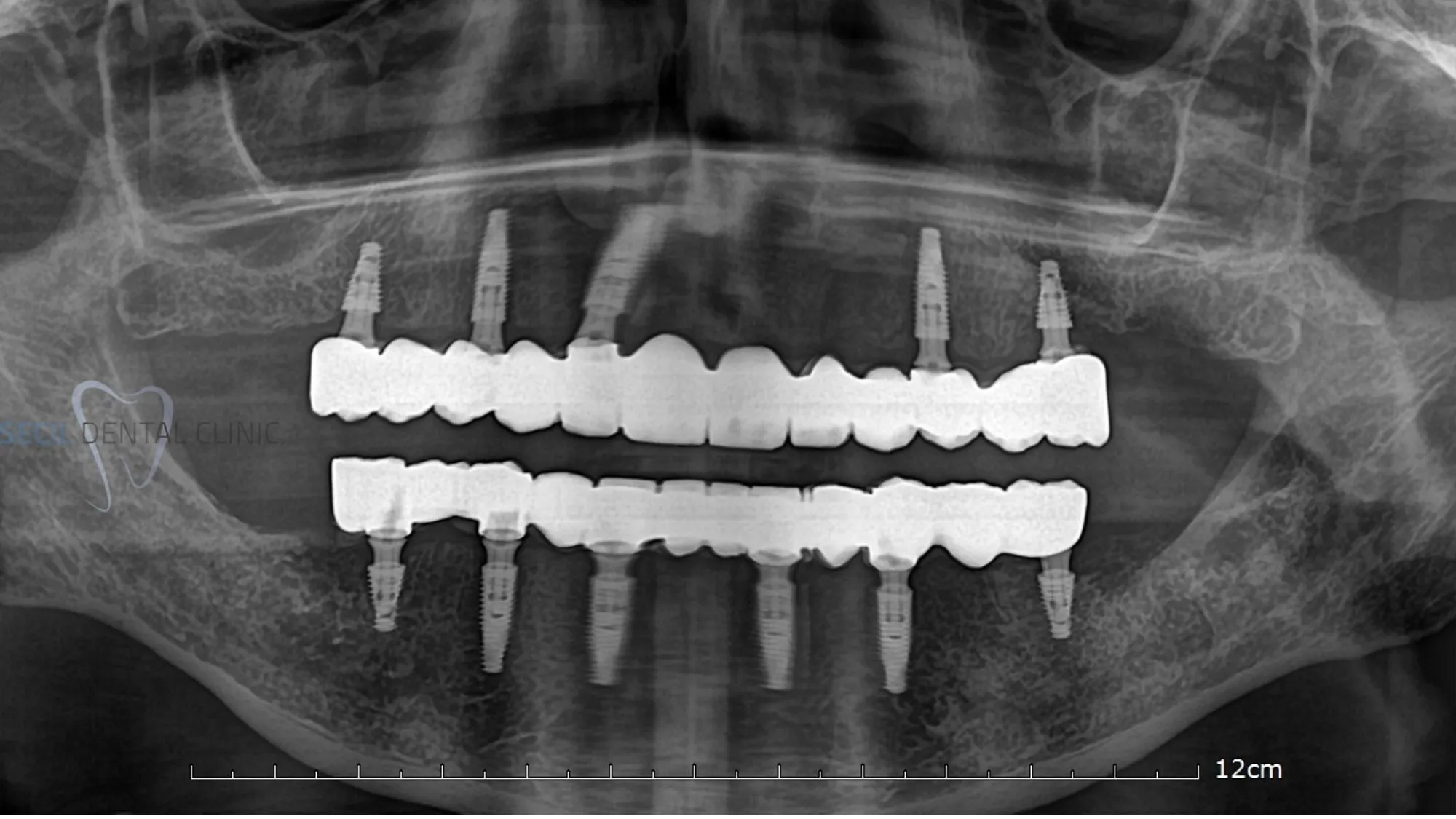 All on 6 dental implants photos