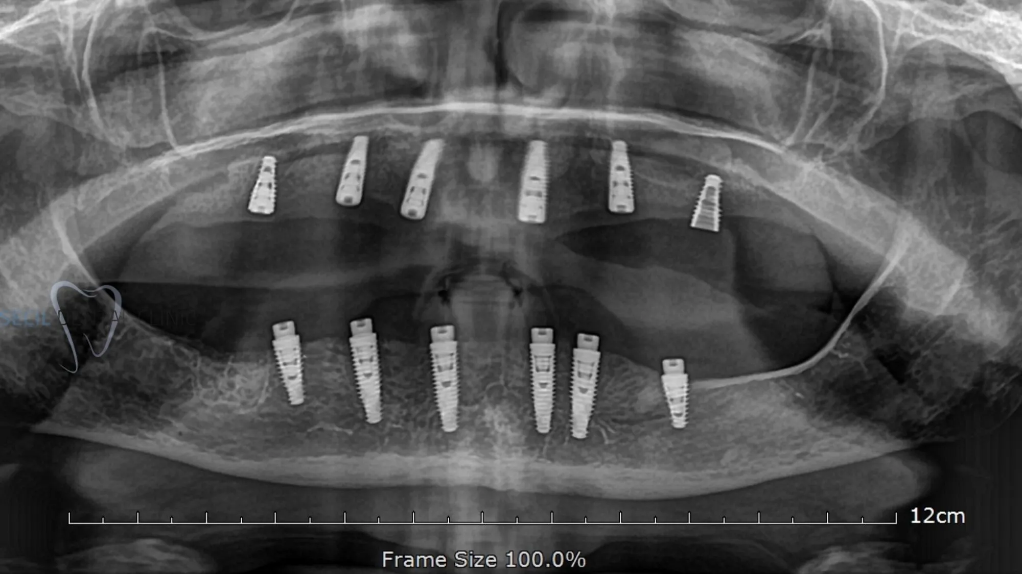 All-on-6 dental implant Turkey