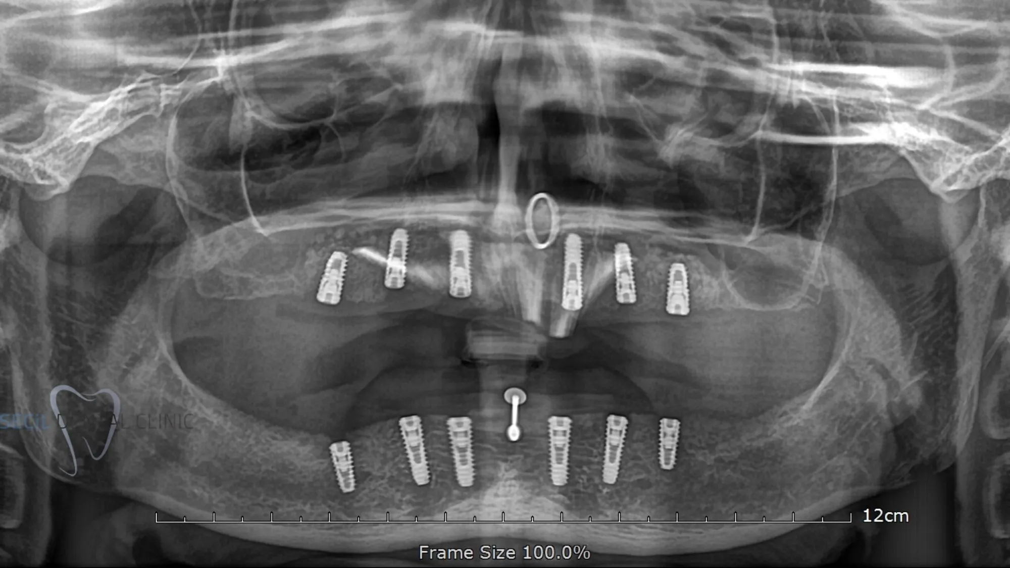 All on 6 dental implants